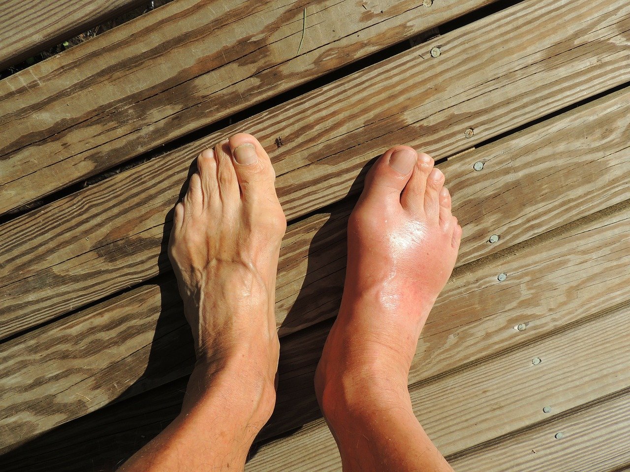 Can CBD Oil help with Gout